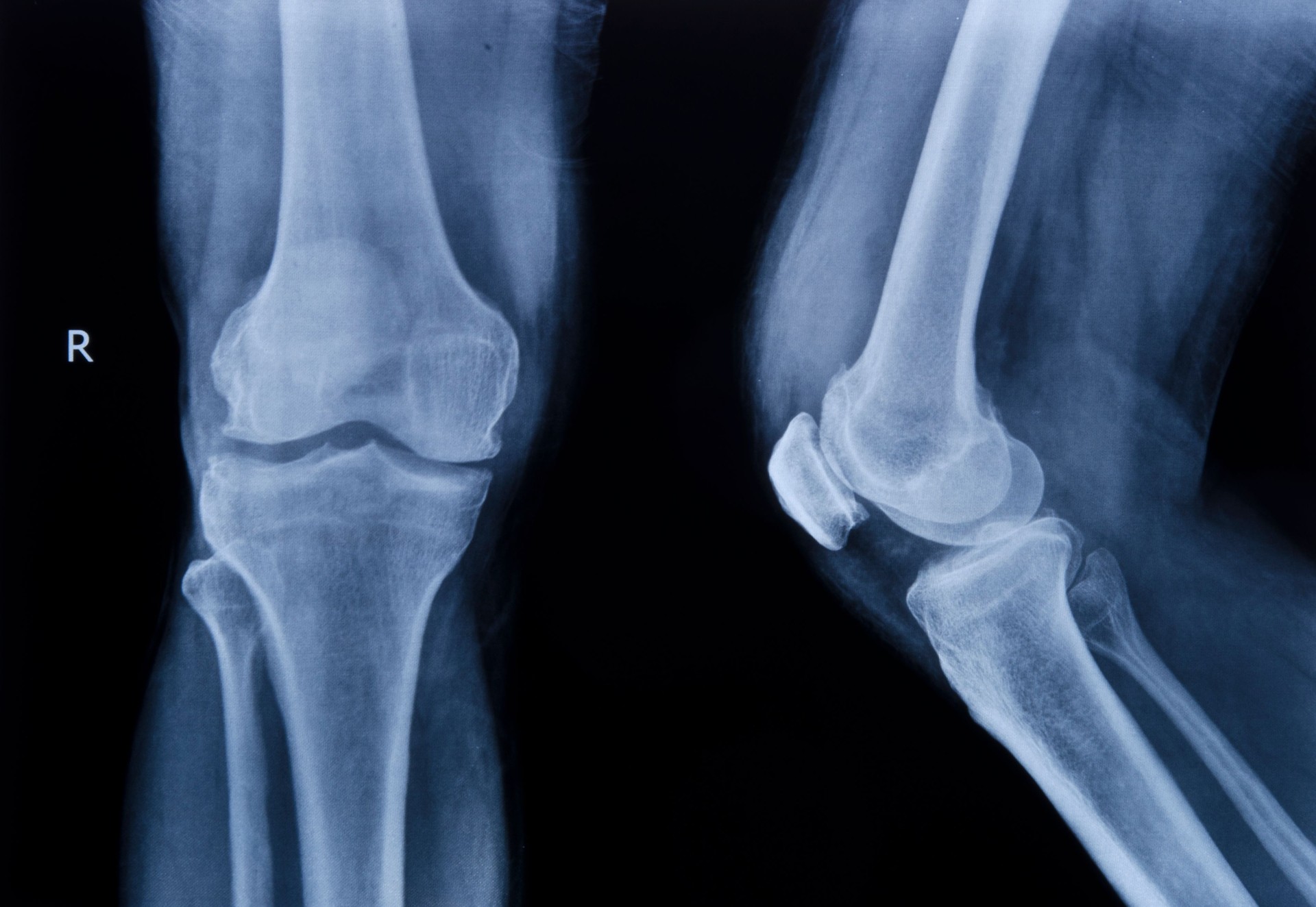 collection of x-ray normal knee